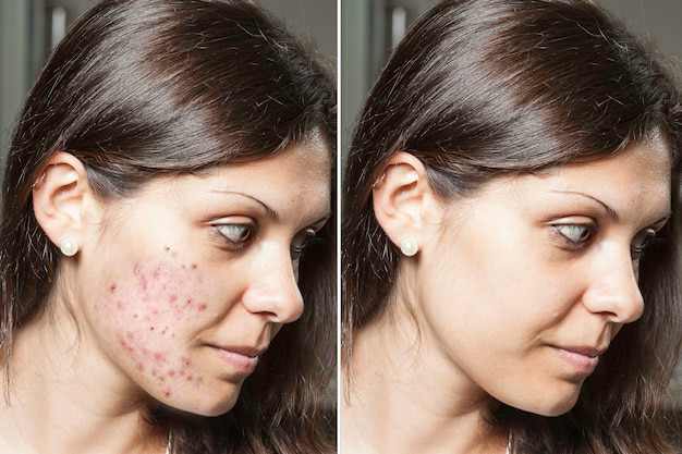 young woman with brunette hair shows before after results successful acne treatment spots scars have been removed through application prescribed topical creams 651462 824