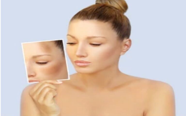 How to Remove Pigmentation